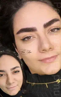 هایپرلیفت سوپرنچرال (میکرو ابرو)