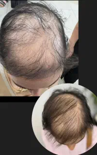 زیبایی، درمان ریزش مو با متریال گیاهی