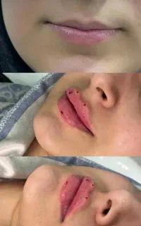 مدل ژل لب با فیلر تک سی سی توسط پزشک