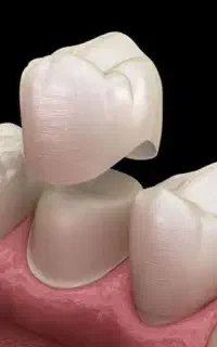 روکش دندان با هزینه‌ی مناسب