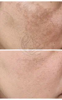 رفع تضمینی لک های پوستی با بازگشت هزینه