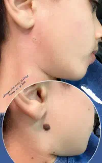 برداشتن دائمی خال، لکه های پوستی، بدون هیچ دردی