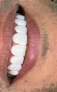 آموزشگاه دندانپزشکی دستیار دندانپزشکی کامپوزیت