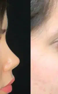عمل زیبایی بینی در اهواز