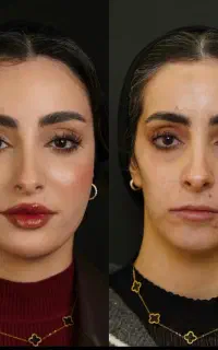 ژل مزوژل فیلر لب بوتاکس فول فیس