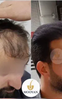 جشنواره‌کاشت‌مو(VIP)۲۴تومن کاشت ابرو۱۴‌(اقساطی)
