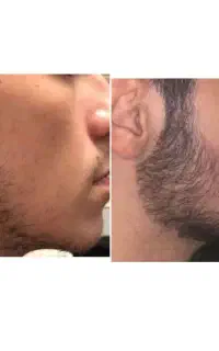 تقویت ریش برای ظاهری یکدست‌تر