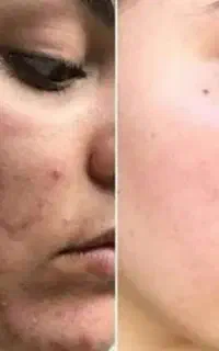 مزوتراپی پی ار پی و مزوژل کلینیک