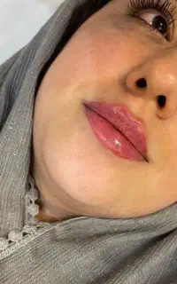 تزریقات ژل و بوتاکس