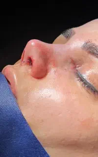 اف ویژه عمل بینی فقط ۳۰ملیون تومان