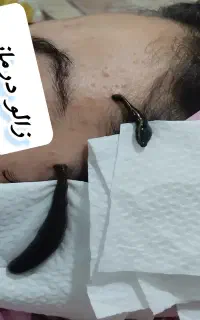 حجامت، فصد خون، زالو درمانی در منزل
