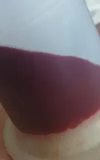 حجامت اسلامی بادکش گرم فصد سیاتیک دیسک