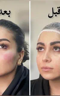 ساکشن غبغب ، لیفت با نخ ،کانتورینگ و جوانسازی