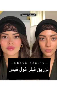 آف آموزش و تزریق فوق تخصصی فیلر بوتاکس(بمدت محدود)