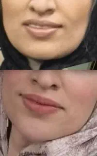 فیلربوتاکس مزوتراپی پی آرپی کاشت مووابرو چسب بخیه