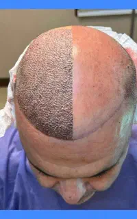 آموزش تخصصی کاشت موهمراه باکار با ارائه مدرک معتبر