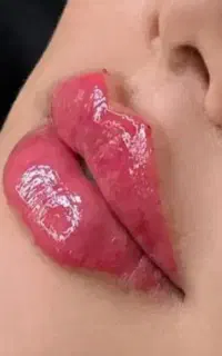 تخفیف ویژه ژل وبوتاکس