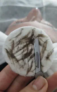 اصلاح درماپلنینگ