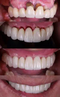 دندانپزشکی پایه ایمپلنت کره ۱۵تومن بدون پیش پرداخت