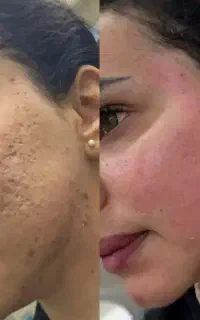 اف ویژه ۳روزه پاک کردن کک ومک فقط دوروزه