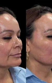 مطب پزشک/فیلر/مزو/پی آر پی/prp
