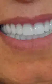 ساخت دندان مصنوعی /طرح کا مپوزیت . قیمت مناسب