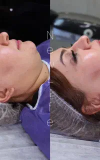لیپوفیس به ب روش v-line