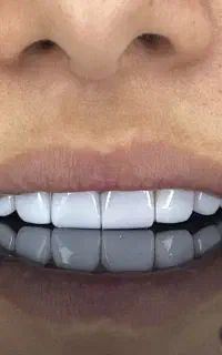 کامپوزیت زیبایی دندان