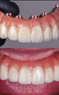 ایمپلنت اقساطی بدون پیش پرداخت.ارتودنسی.دندانپزشکی