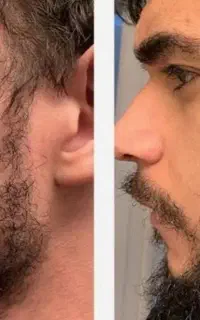 مزوتراپی ممنوع