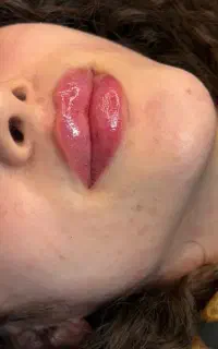 تزریق ژل بوتاکس نخ لیفت فیلر بادی ‌آنزیم مزو