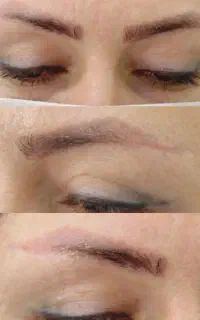 کاشت ابروی گیسو
