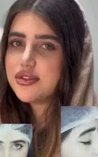 عمل بینی پیکرتراشی ابدولیپو ژل بوتاکس اقساط بی سود