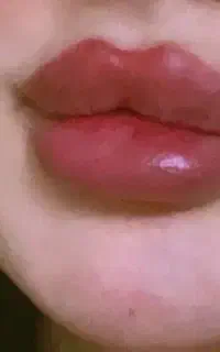 جشنواره خدمات تخصصی ژل و بوتاکس