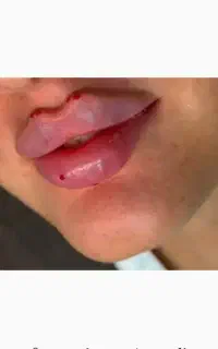 تزریق ژل وبوتاکس ژل لب گونه چانه زاویه خط لبخند