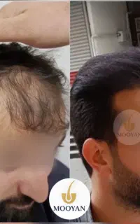جشنواره‌کاشت‌مو(VIP)۲۴تومن کاشت ابرو۱۴‌(اقساط)