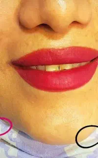 تخفیف فیلر / بوتاکس  / جوانساز / مزو و