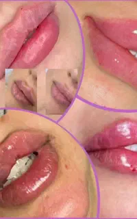 فیلر لب و صورت و بدن وبوتاکس