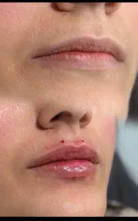 فشیال رفع غبغب ژل وبوتاکس
