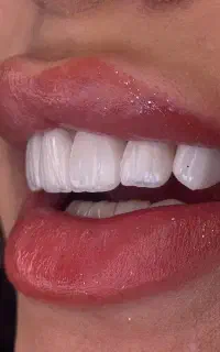 کامپوزیت لمینیت ایمپلنت با شرایط و اقساط ویژه