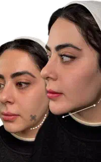 فیلر بینی کانتورینگ زیر چشم لیفت صورت بوتاکس مزوژل