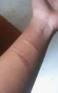 پزشکی. درمان خودزنی و جای زخم