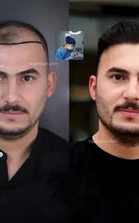 کاشت مو با ۱۲ میلیون تخفیف