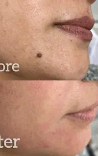 برداشتن انواع خال و منگوله