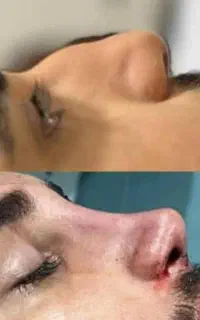 آف محدودجراحی بینی دراهوازفق۲۵ت