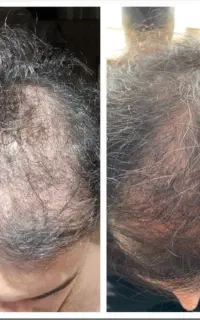 تخفیف ویژه درمان ریزش مو + مکمل تقویت کننده رایگان