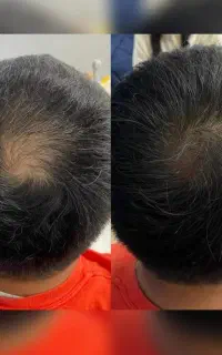 پرپشتی موها فقط توی یک ماه