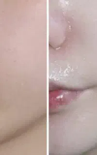 سفیدی و شفافی پوست با آمپول گلوتاتیون