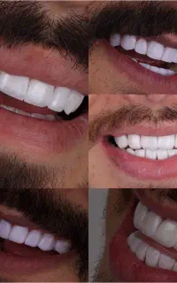 کامپوزیت لمینت