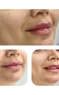 تخفیف ویژه فیلر لب ‌ صورت